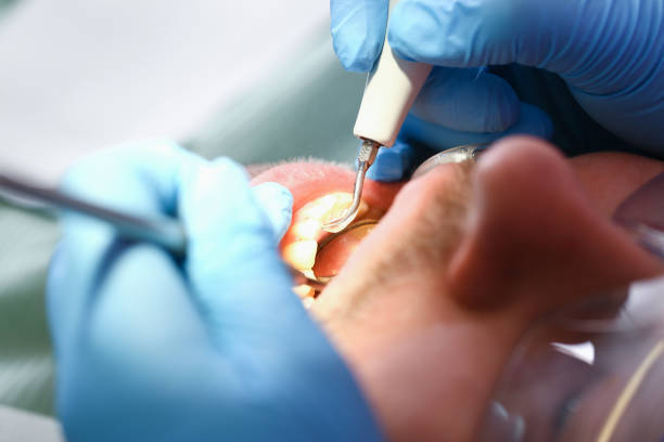 Best Emergency Treatment for Dental Infections or Abscesses in Byesville, OH